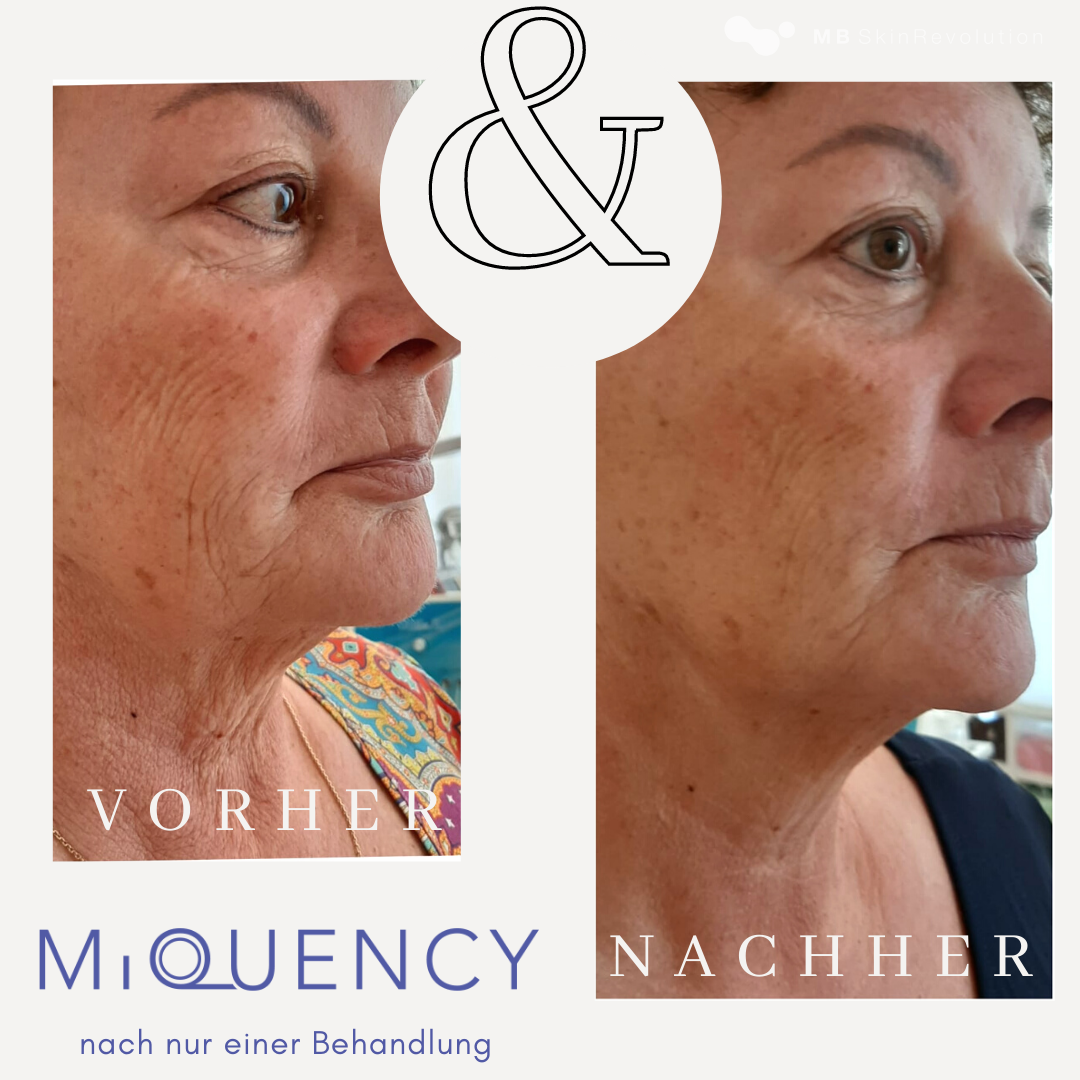 Vorher-Nachher-Vergleich RF-Needling mit MiQuency, Beispiel 6