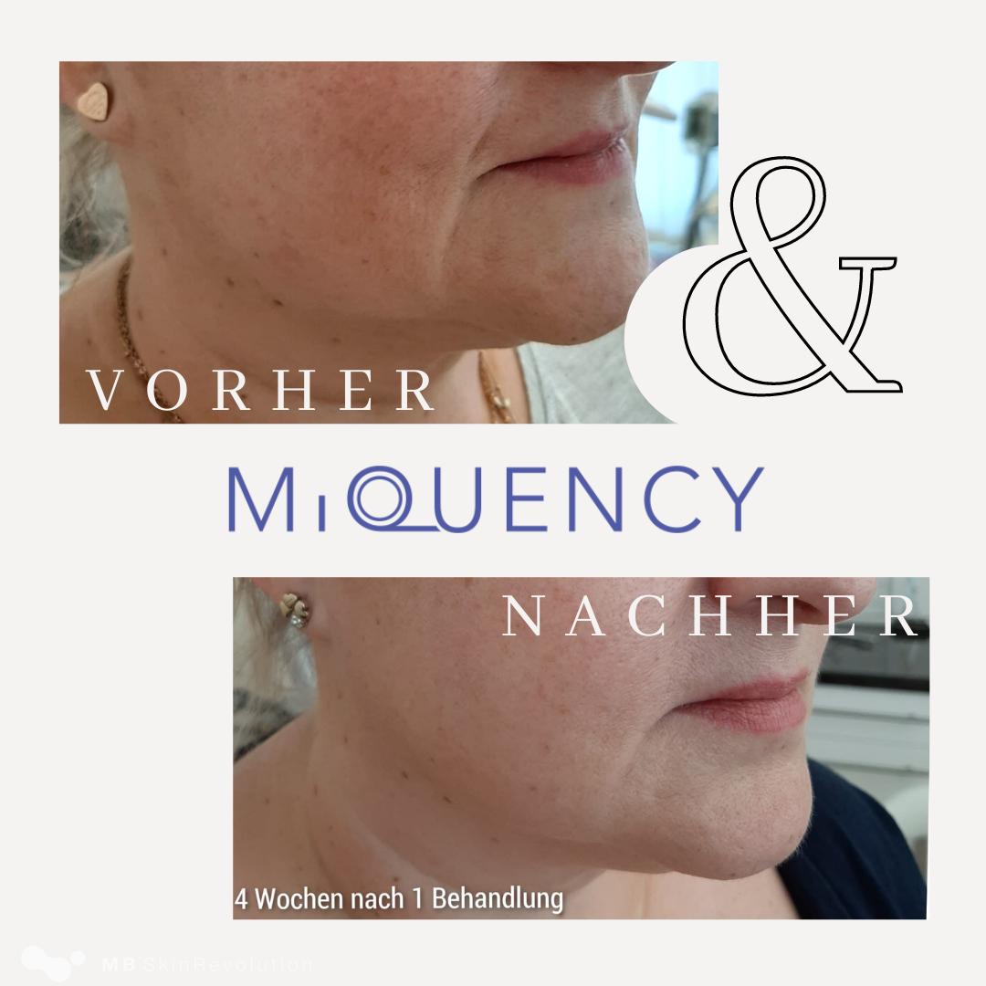 Vorher-Nachher-Vergleich RF-Needling mit MiQuency, Beispiel 4