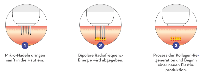 Ablauf in drei Schritten: 1. Mikro-Nadeln dringen sanft in die Haut ein. 2. Bipolare Radiofrequenz-Energie wird abgegeben. 3. Prozess der Kollagen-Regeneration und Beginn einer neuen Elastinproduktion.
