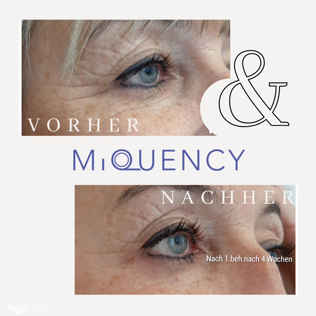 Vorher-Nachher-Vergleich RF-Needling mit MiQuency, Beispiel 3