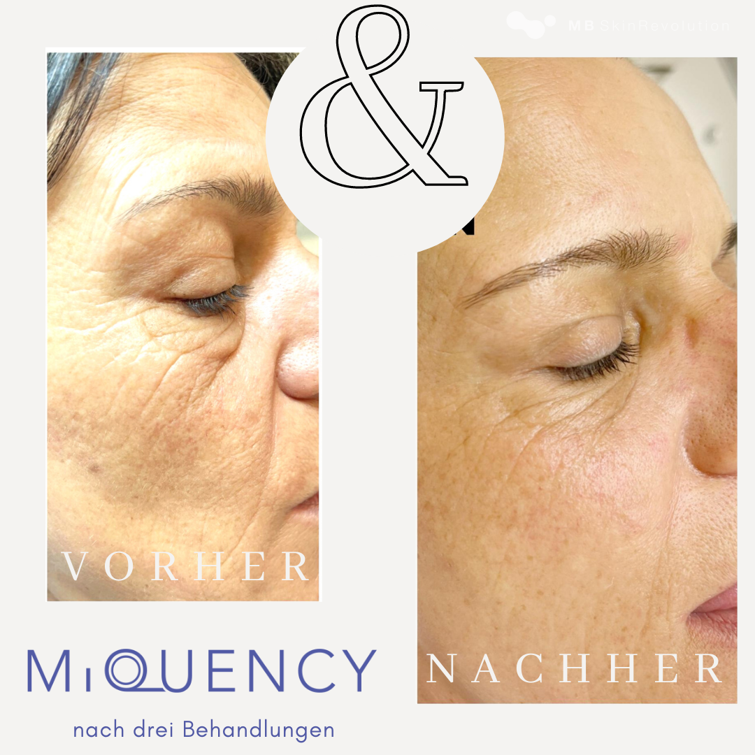 Vorher-Nachher-Vergleich RF-Needling mit MiQuency, Beispiel 5