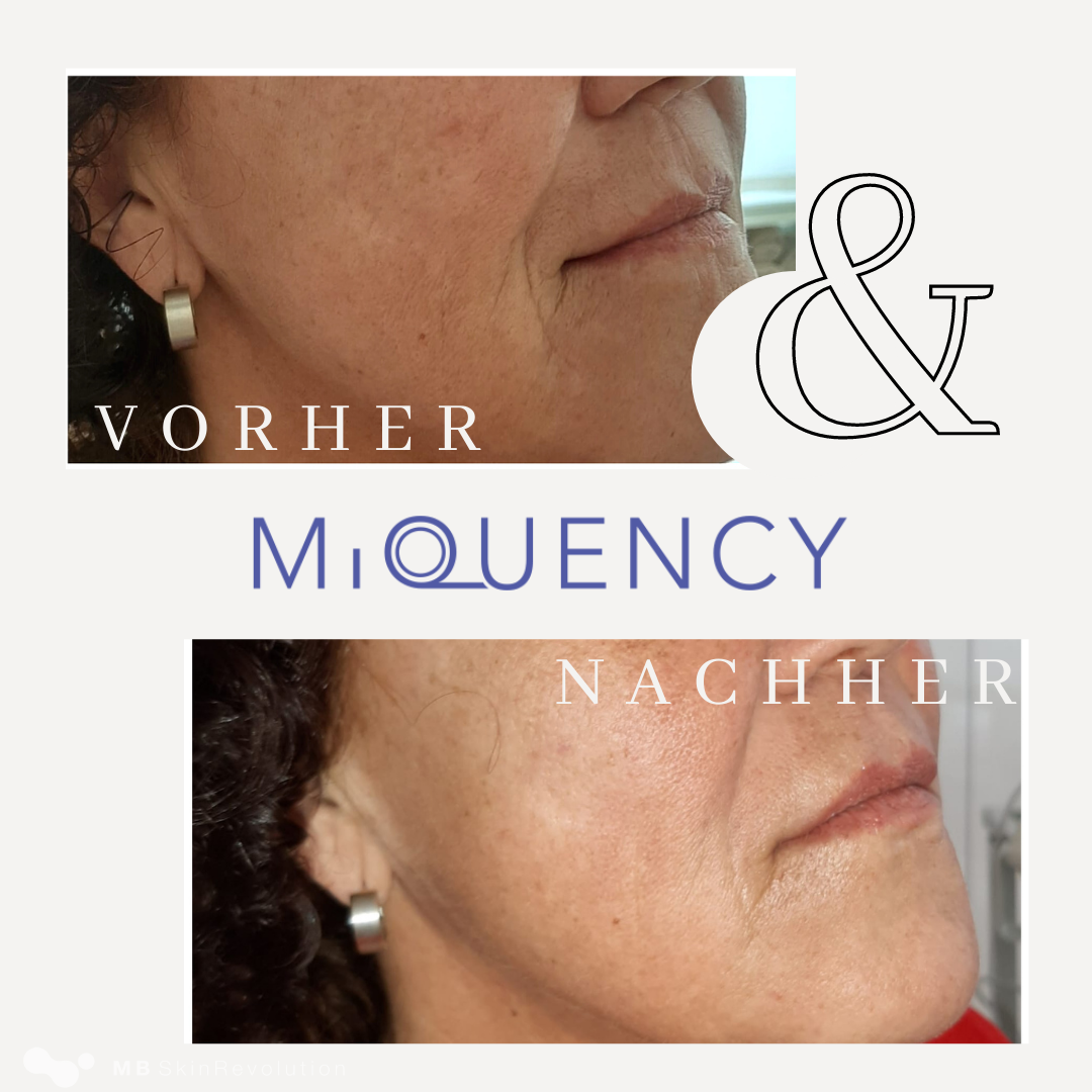 Vorher-Nachher-Vergleich RF-Needling mit MiQuency, Beispiel 1